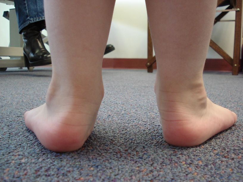 Flat Feet Problem 